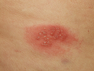 Picture of Genital Herpes on the anogeni... - skinsight.com