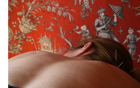 Terapia de acupuntura